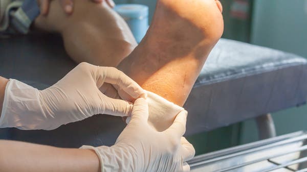 لقرحة القدم ‏السكرية.. علاج من القرون الوسطى