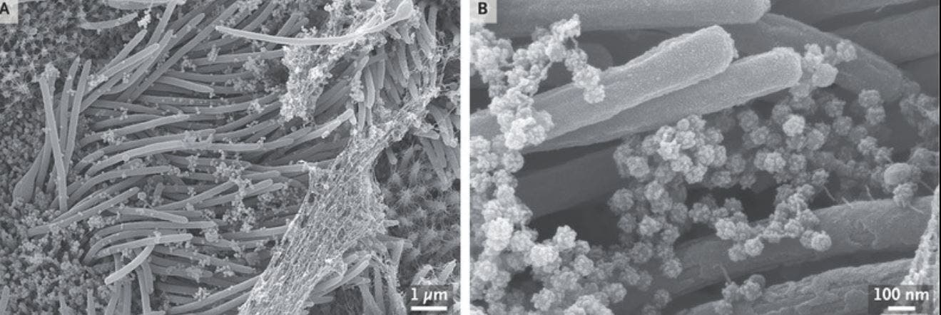 صورة مرعبة لمجار تنفسية تعجّ بكورونا.. لن تصدق عينيك!