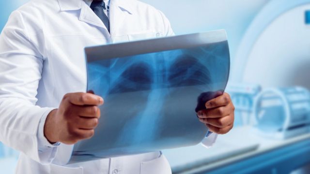 فيروس كورونا: دراسة ترصد “ضررا في الرئة” يطول أمده بعد الإصابة بكوفيد-19