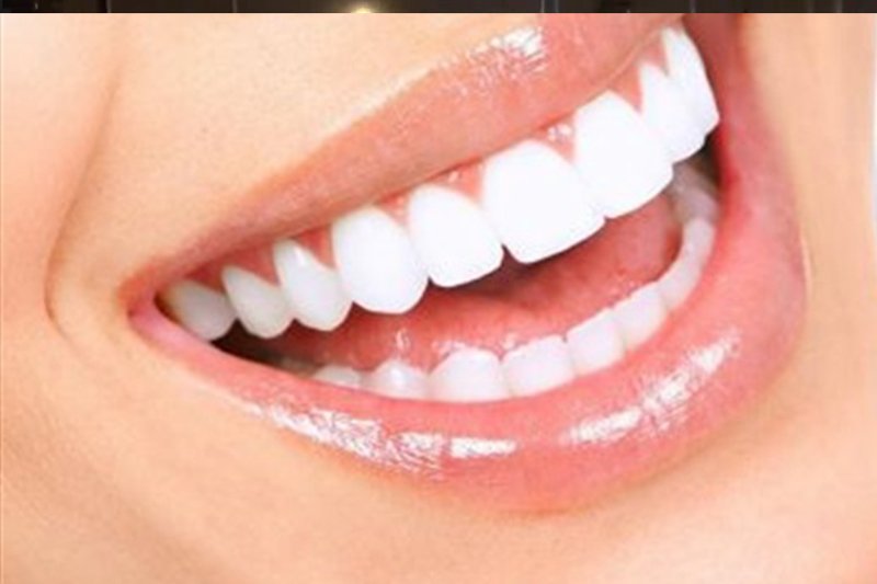 ابتسامة هوليوود