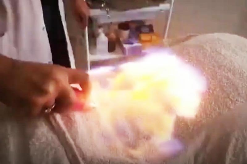 الحجامة بالفوطة النارية