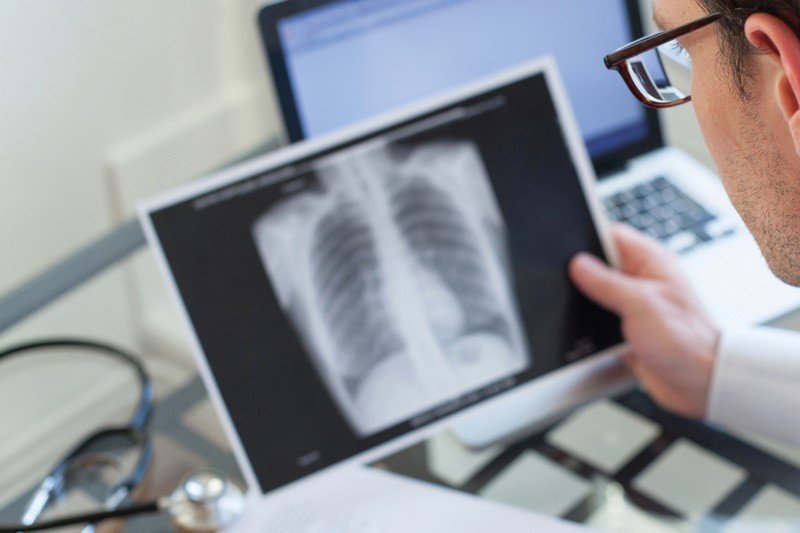 أطباء الدار البيضاء يدقون ناقوس الخطر بشأن 6 آلاف إصابة بداء السل