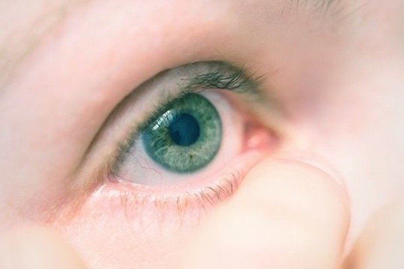 كيف تواجه “دمل الجفن”؟