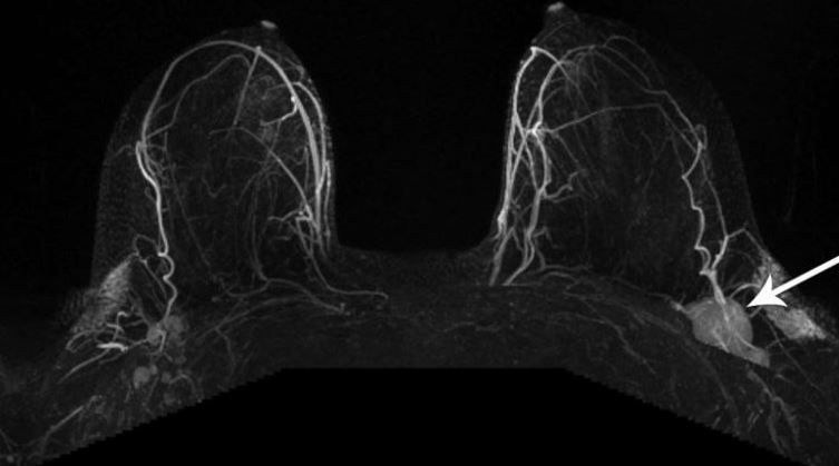 لا داعي للقلق.. فحص الثدي بالأشعة يُظهر التورم بسبب لقاح كورونا!
