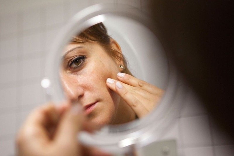 ما هي البثور الهرمونية؟