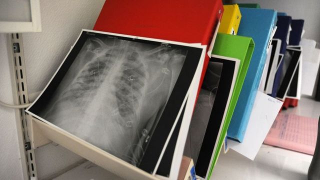 أول عملية زرع رئة من متبرع حي في العالم لمريضة بفيروس كورونا في اليابان