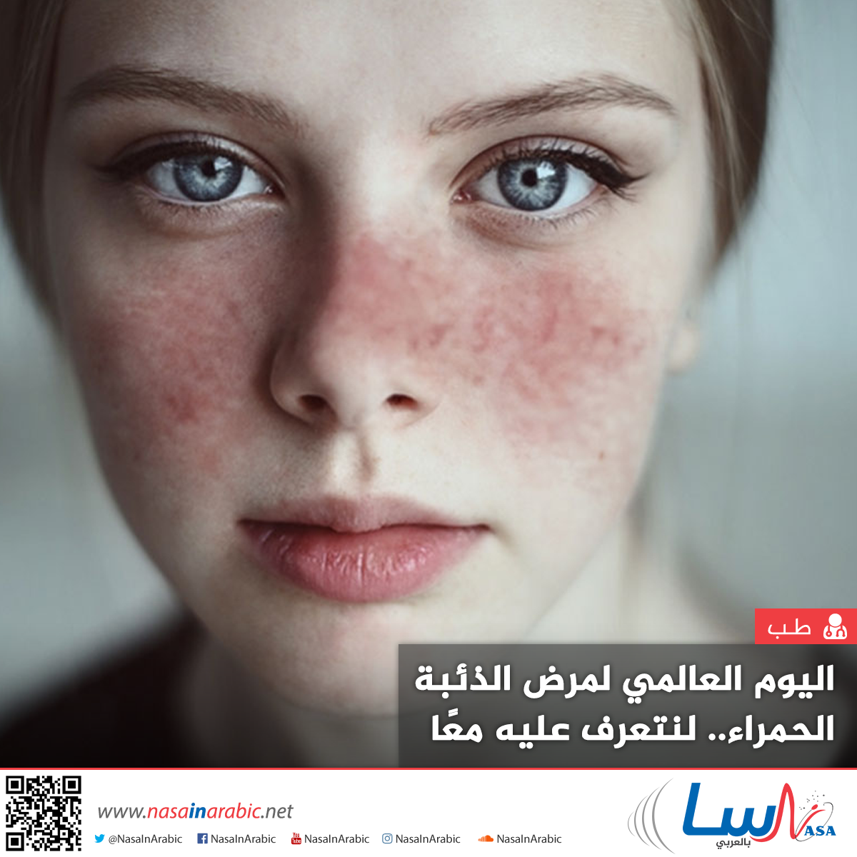 اليوم العالمي لمرض الذئبة الحمراء.. لنتعرف عليه معًا