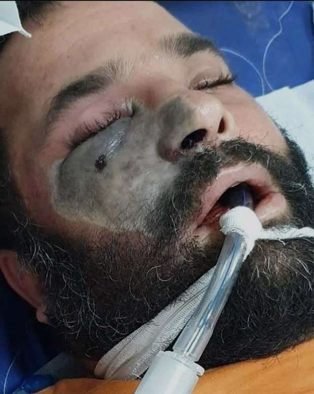 بعد الأبيض والأسود.. ظهور فطر أصفر أشد فتكاً بالهند