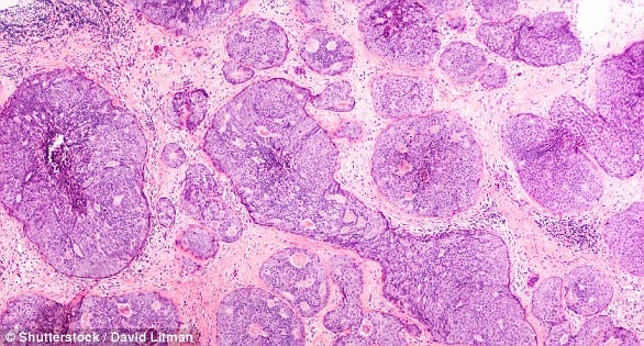 أمل يلوح للخلاص من سرطان الثدي.. عقار قضى عليه بنسبة 99%