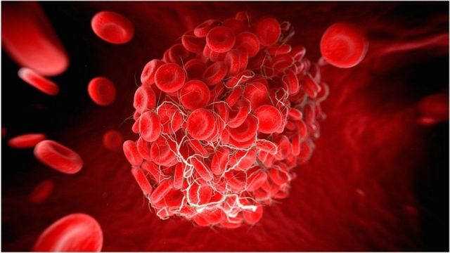 لقاح فيروس كورونا: مخاطر تجلط الدم أو السكتة الدماغية من اللقاح “أقل” مقارنة بالإصابة بكوفيد