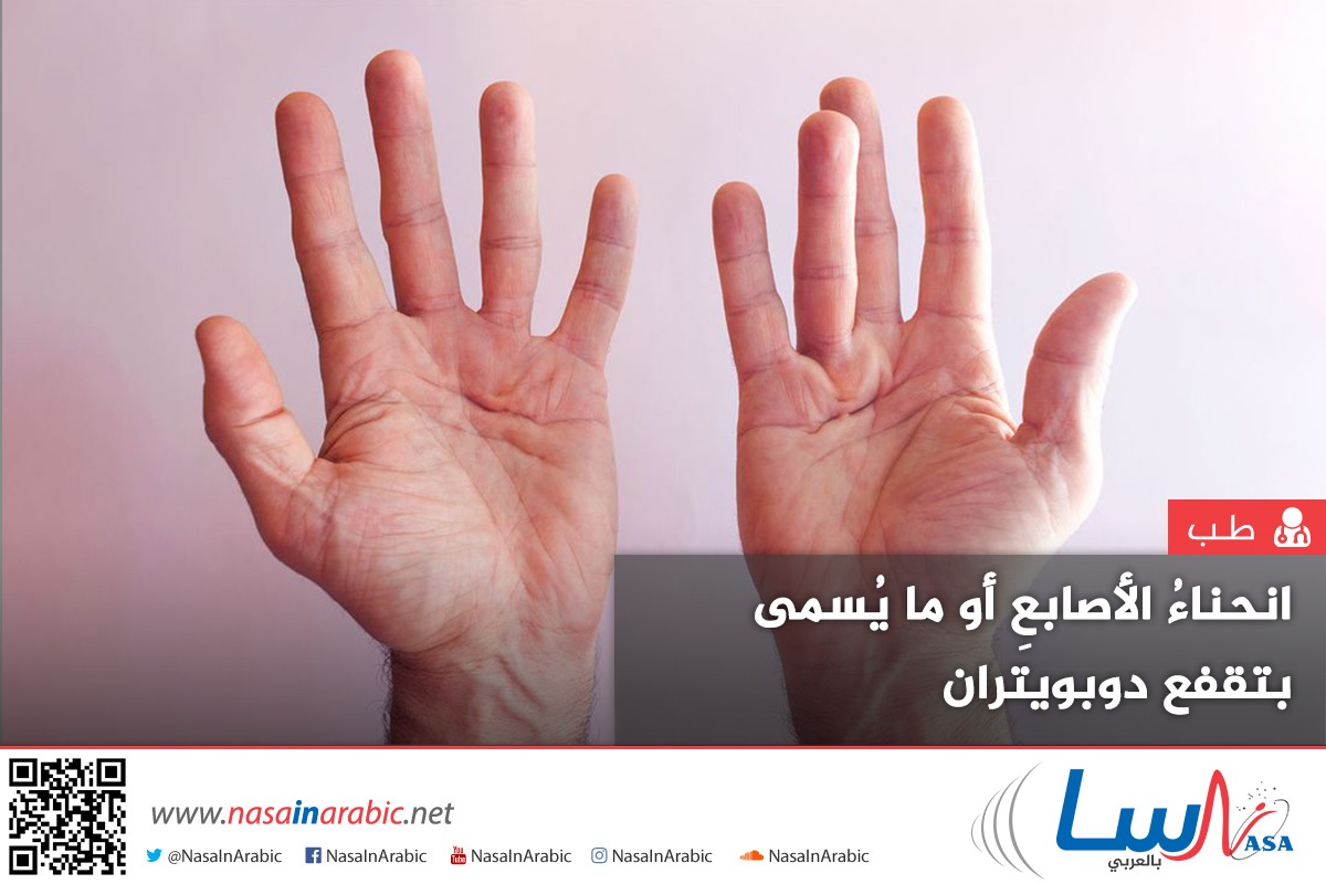 انحناءُ الأصابعِ أو ما يُسمى بتقفع دوبويتران