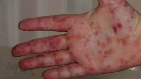 أعراض إنفلونزا الطماطم.. فيروس جديد قادم من الهند