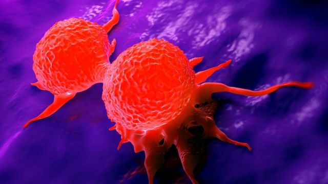 توصية باستخدام أداة جديدة تشبه “كاشف المعادن” لعلاج سرطان الثدذي في بريطانيا