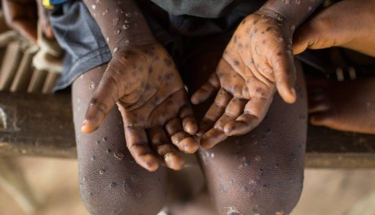 الصحة العالمية : أوروبا مركز انتشار جدري القردة