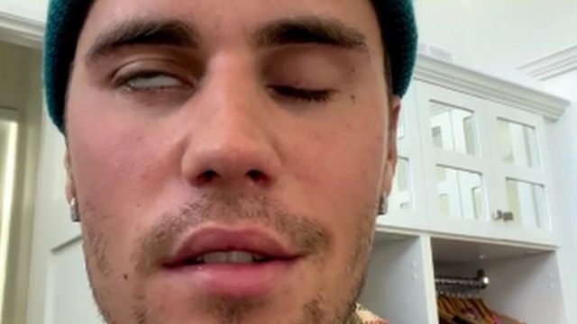 جاستن بيبر: ما هي متلازمة رامزي هانت التي أصابت نجم البوب الكندي؟