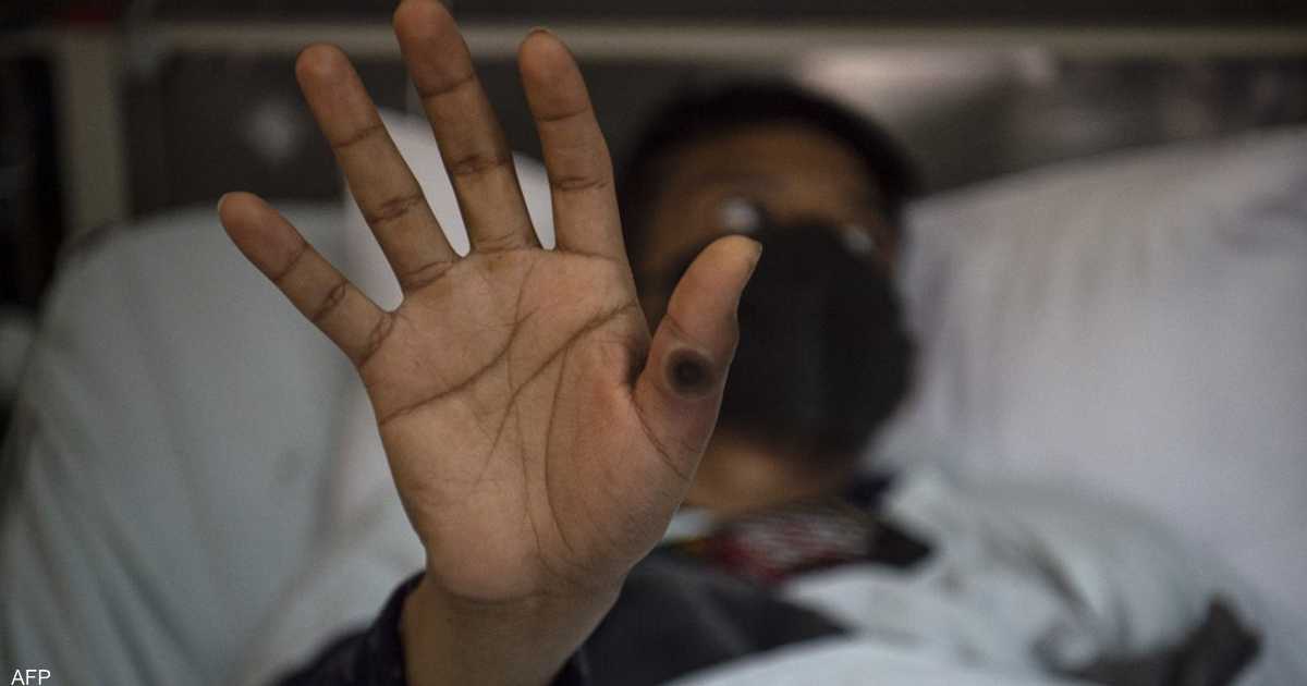 حالة المصاب “حرجة”.. جدري القردة يظهر في دولة جديدة